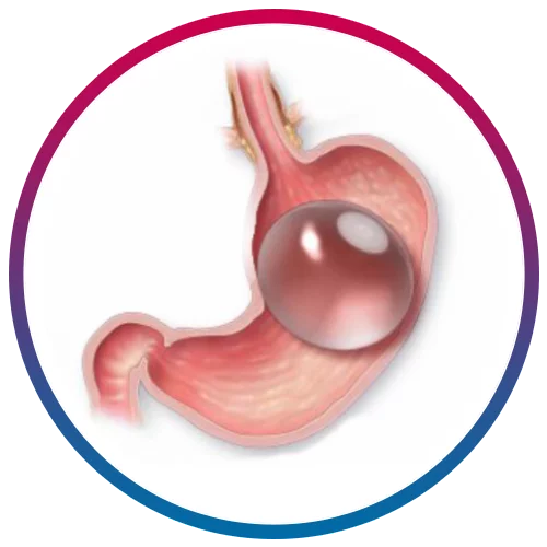 GASTRIC BALLOON