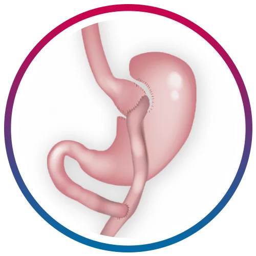 GASTRIC BYPASS